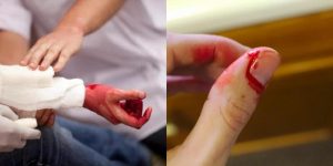 nằm mơ thấy đứt tay